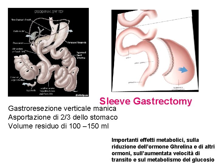 Sleeve Gastrectomy Gastroresezione verticale manica Asportazione di 2/3 dello stomaco Volume residuo di 100