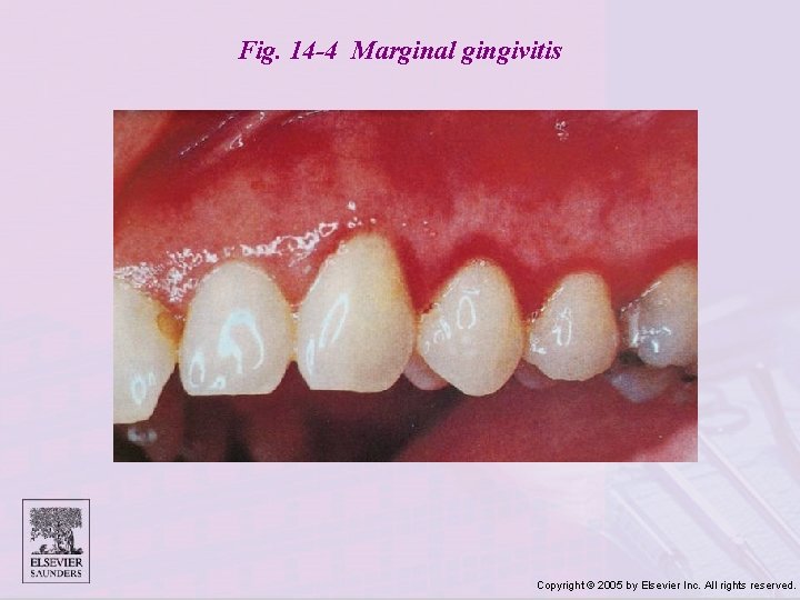 Fig. 14 -4 Marginal gingivitis Copyright © 2005 by Elsevier Inc. All rights reserved.