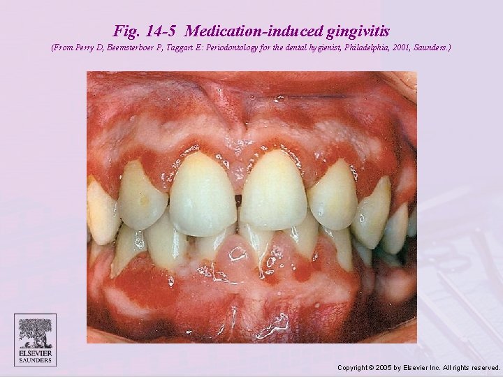 Fig. 14 -5 Medication-induced gingivitis (From Perry D, Beemsterboer P, Taggart E: Periodontology for