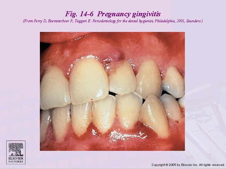 Fig. 14 -6 Pregnancy gingivitis (From Perry D, Beemsterboer P, Taggart E: Periodontology for