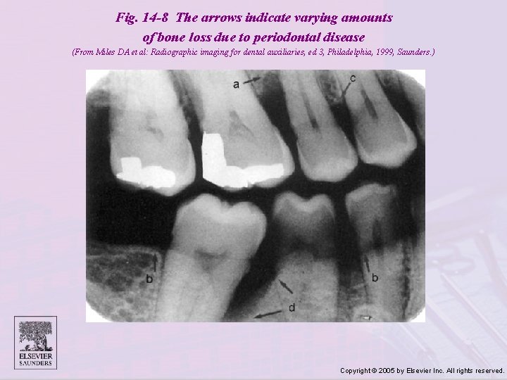 Fig. 14 -8 The arrows indicate varying amounts of bone loss due to periodontal