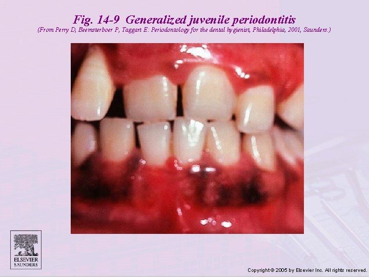 Fig. 14 -9 Generalized juvenile periodontitis (From Perry D, Beemsterboer P, Taggart E: Periodontology