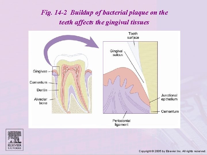 Fig. 14 -2 Buildup of bacterial plaque on the teeth affects the gingival tissues