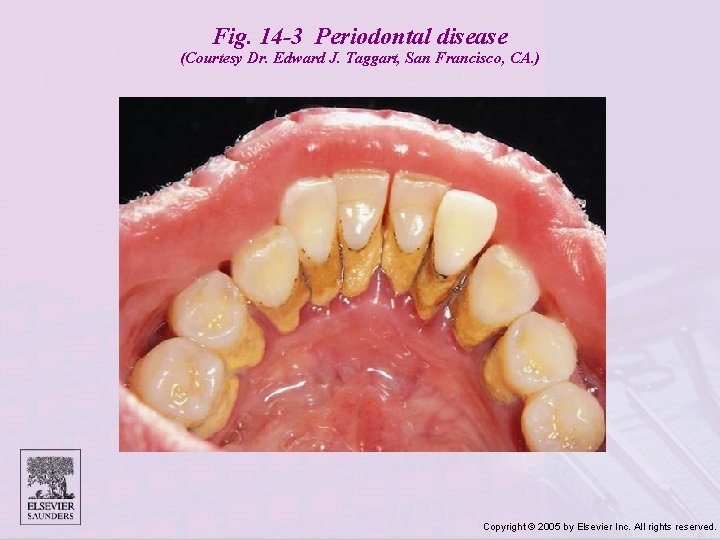 Fig. 14 -3 Periodontal disease (Courtesy Dr. Edward J. Taggart, San Francisco, CA. )