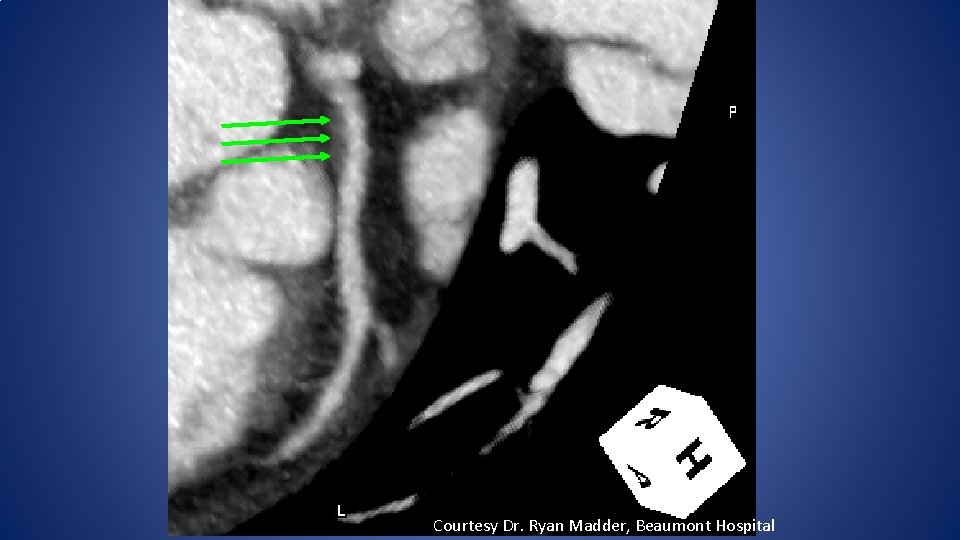 Courtesy Dr. Ryan Madder, Beaumont Hospital 