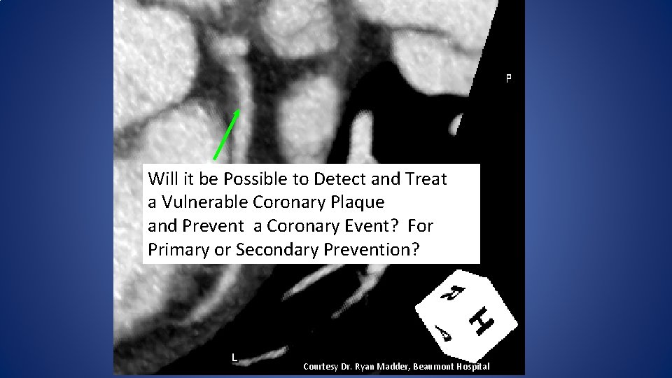 Will it be Possible to Detect and Treat a Vulnerable Coronary Plaque and Prevent