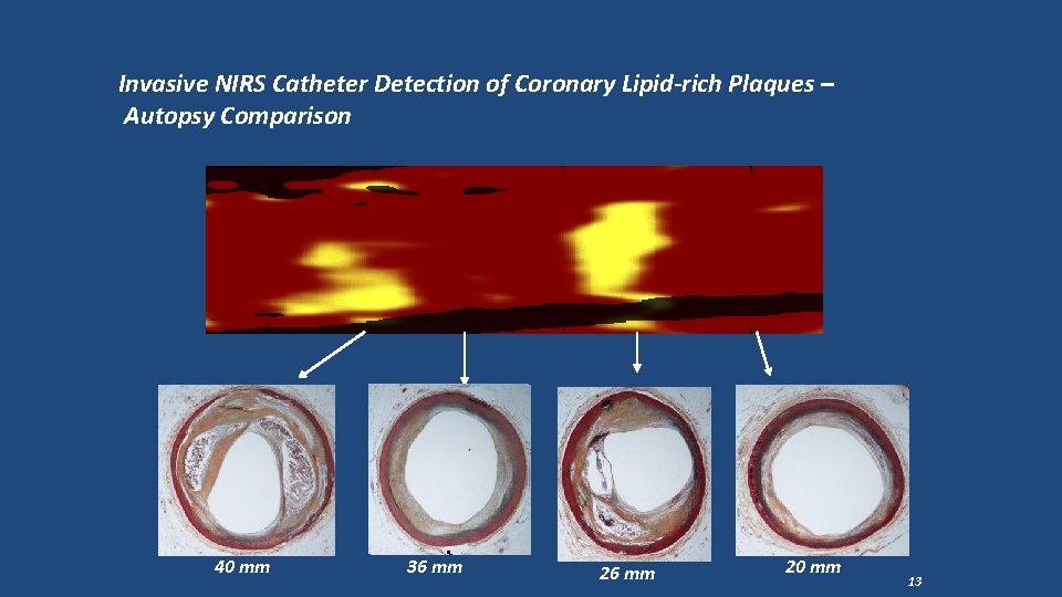 Invasive NIRS Catheter Detection of Coronary Lipid-rich Plaques – Autopsy Comparison 40 mm 36