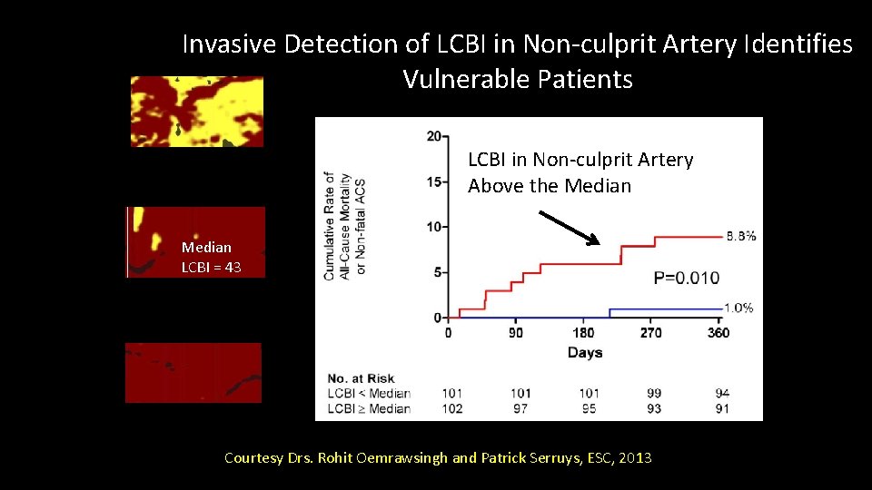 Invasive Detection of LCBI in Non-culprit Artery Identifies Vulnerable Patients LCBI in Non-culprit Artery