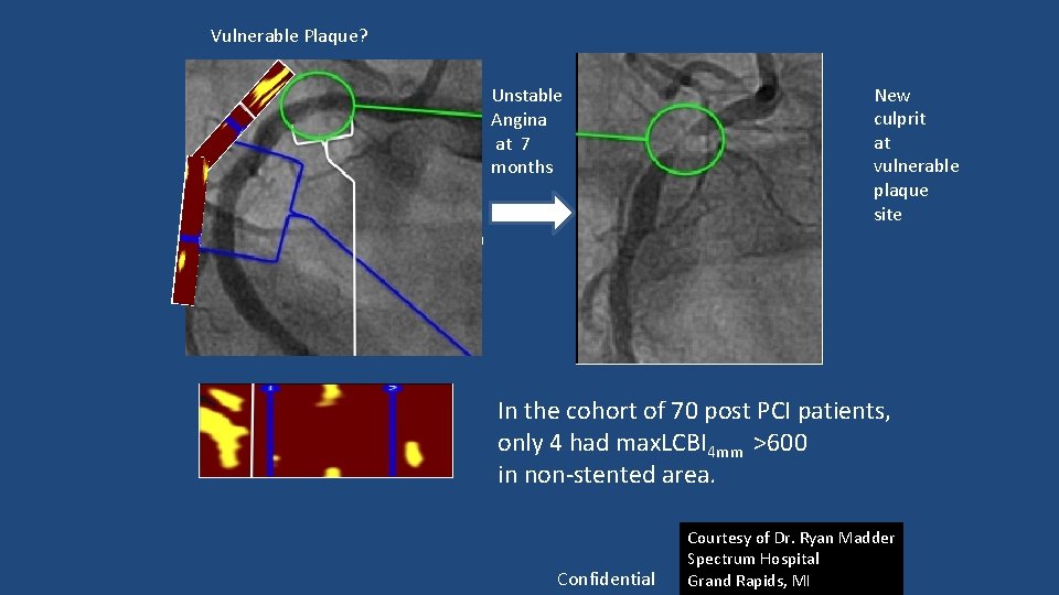 Vulnerable Plaque? Unstable Angina at 7 months Stent placed in STEMI culprit New culprit