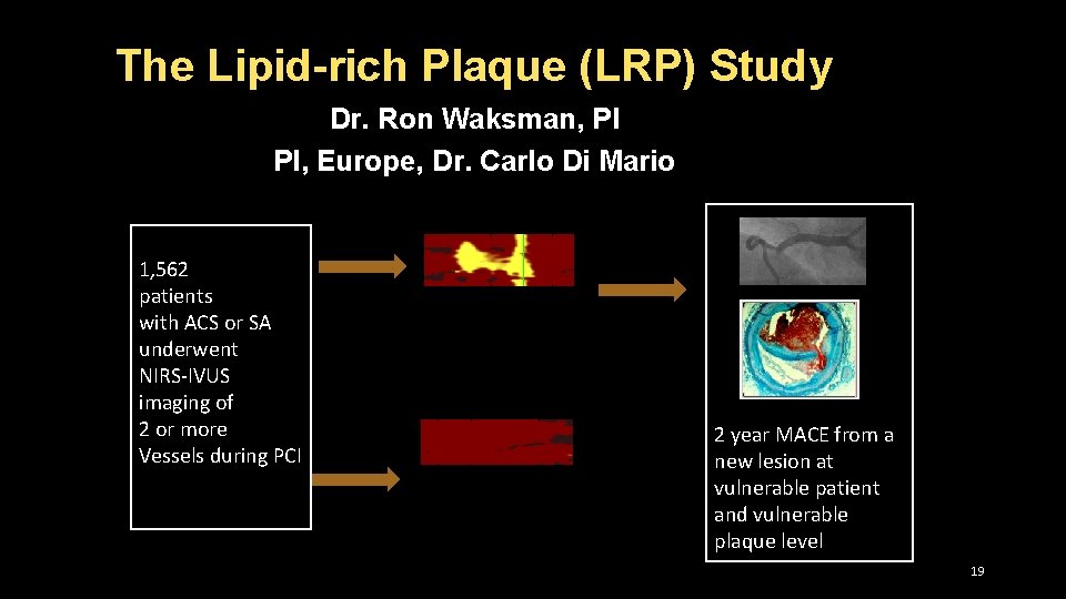 The Lipid-rich Plaque (LRP) Study Dr. Ron Waksman, PI PI, Europe, Dr. Carlo Di