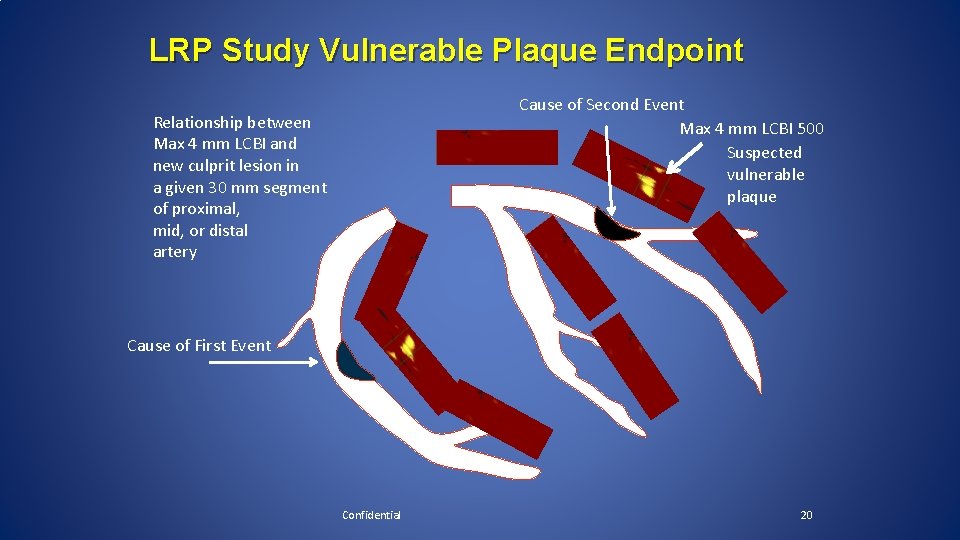 LRP Study Vulnerable Plaque Endpoint Cause of Second Event Max 4 mm LCBI 500