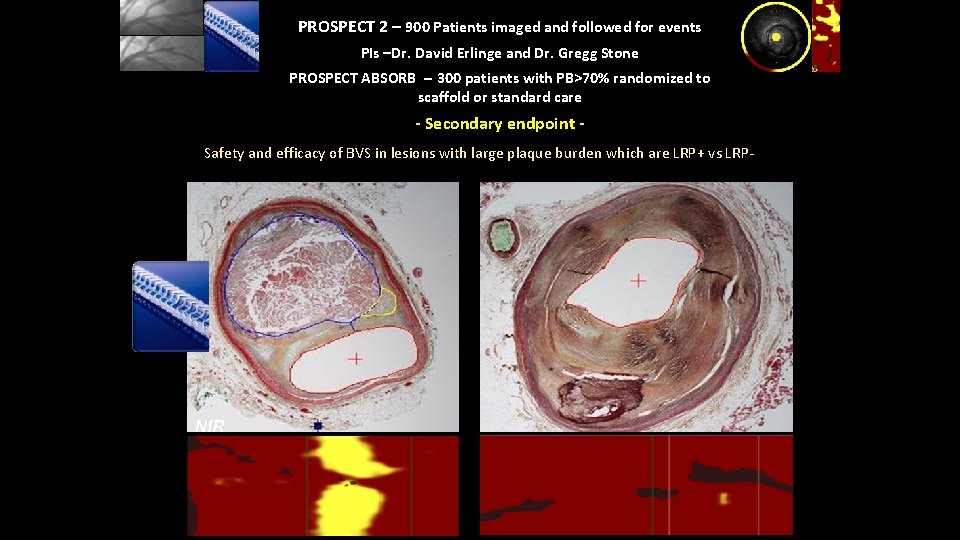 PROSPECT 2 – 900 Patients imaged and followed for events PIs –Dr. David Erlinge