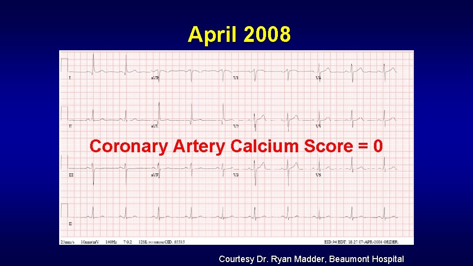 April 2008 Coronary Artery Calcium Score = 0 Courtesy Dr. Ryan Madder, Beaumont Hospital