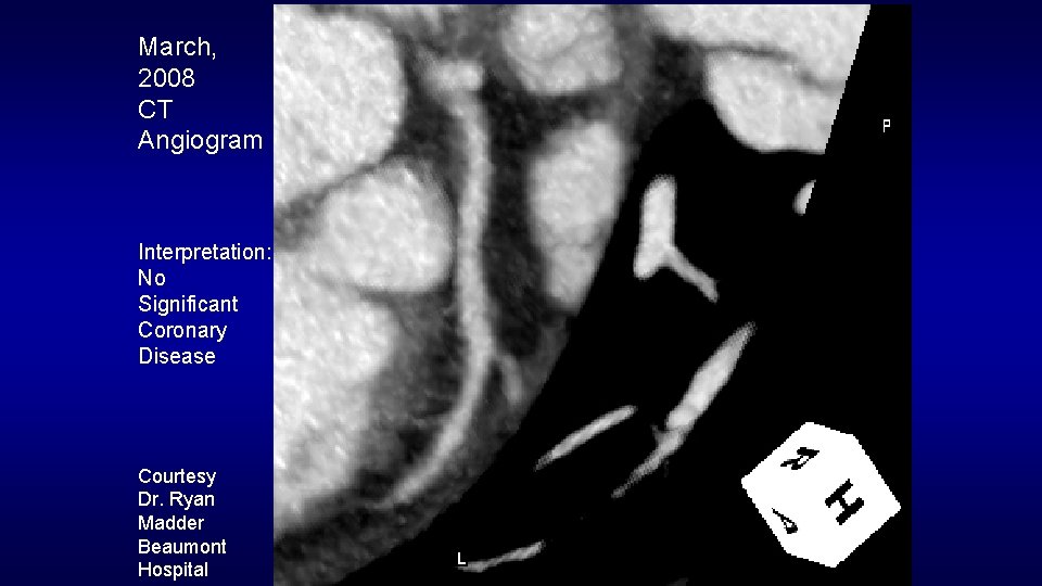 March, 2008 CT Angiogram Interpretation: No Significant Coronary Disease Courtesy Dr. Ryan Madder Beaumont