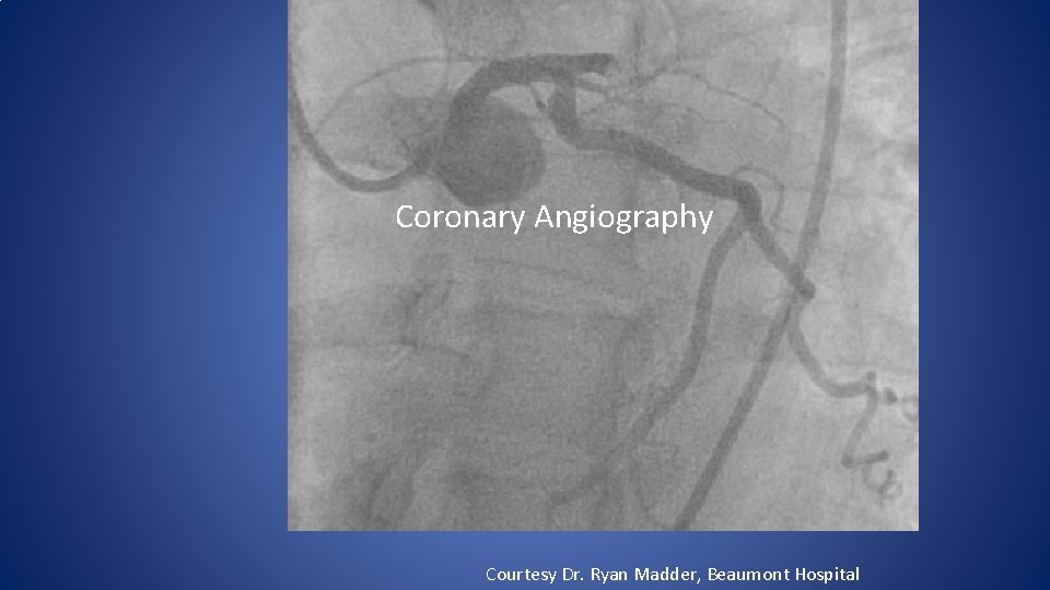 Coronary Angiography Courtesy Dr. Ryan Madder, Beaumont Hospital 