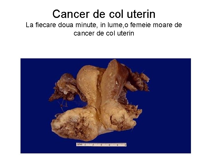 Cancer de col uterin La fiecare doua minute, in lume, o femeie moare de