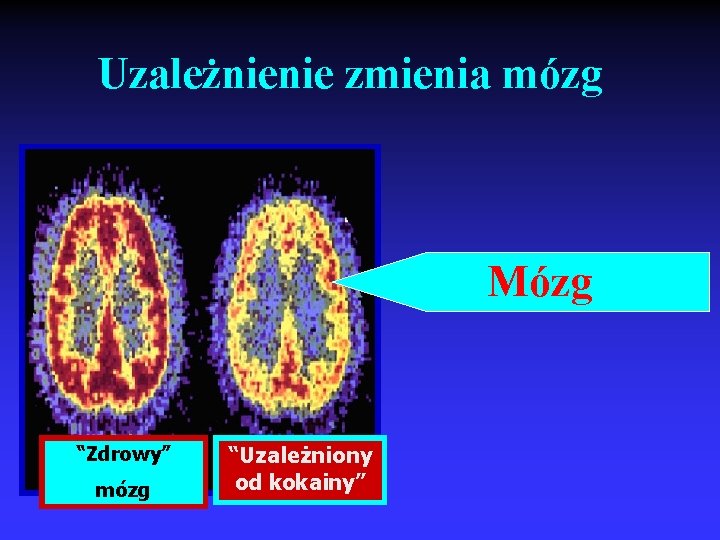Uzależnienie zmienia mózg Mózg “Zdrowy” mózg “Uzależniony od kokainy” 
