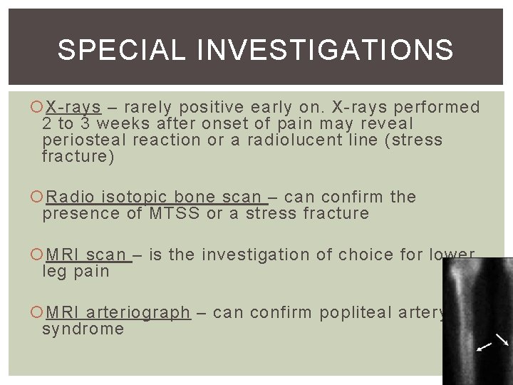 SPECIAL INVESTIGATIONS X-rays – rarely positive early on. X-rays performed 2 to 3 weeks SPECIAL INVESTIGATIONS X-rays – rarely positive early on. X-rays performed 2 to 3 weeks