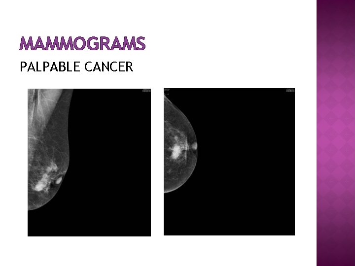 MAMMOGRAMS PALPABLE CANCER 