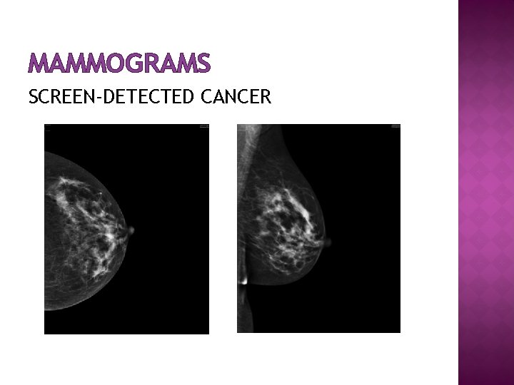 MAMMOGRAMS SCREEN-DETECTED CANCER 