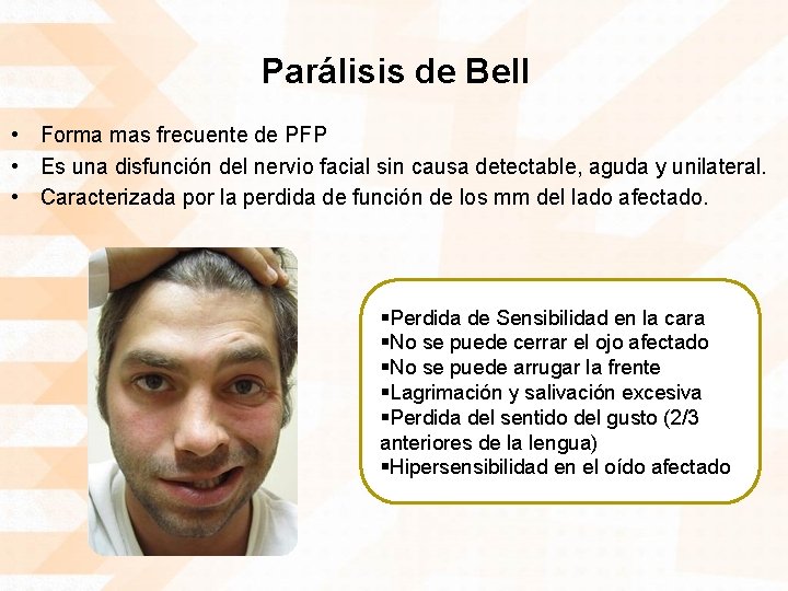Parálisis de Bell • Forma mas frecuente de PFP • Es una disfunción del