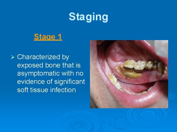 Staging Stage 1 Ø Characterized by exposed bone that is asymptomatic with no evidence
