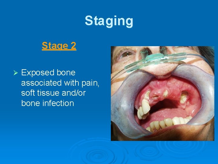 Staging Stage 2 Ø Exposed bone associated with pain, soft tissue and/or bone infection