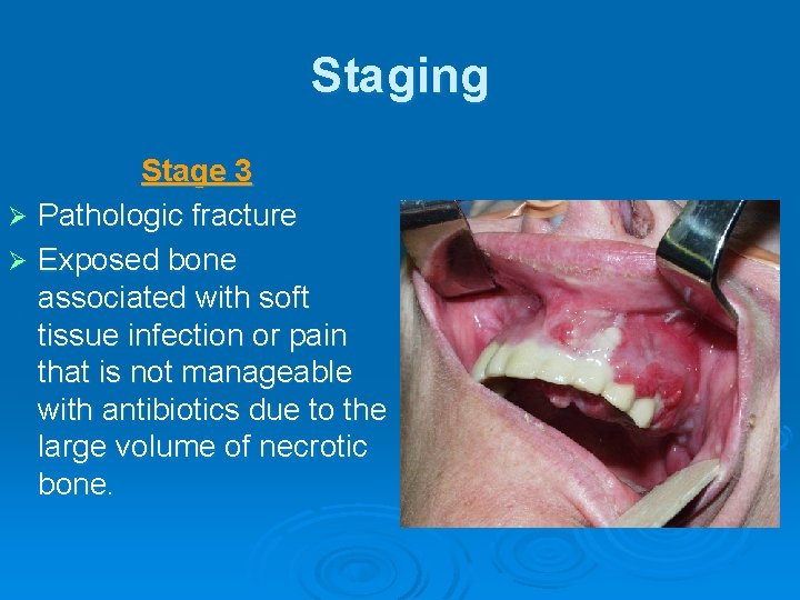 Staging Stage 3 Ø Pathologic fracture Ø Exposed bone associated with soft tissue infection