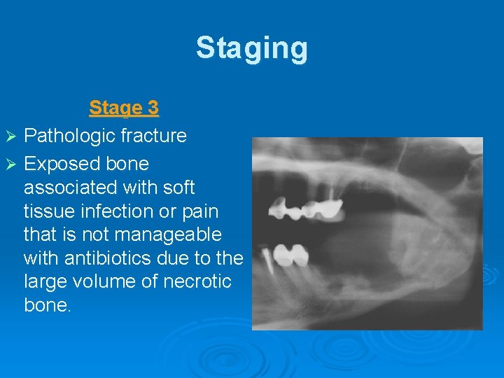 Staging Stage 3 Ø Pathologic fracture Ø Exposed bone associated with soft tissue infection