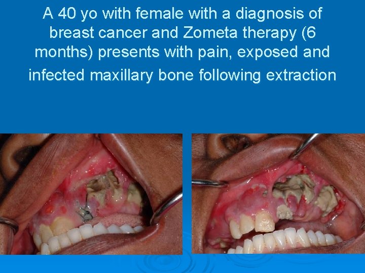 A 40 yo with female with a diagnosis of breast cancer and Zometa therapy