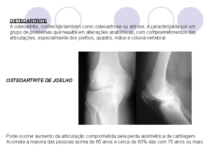 OSTEOARTRITE A osteoartrite, conhecida também como osteoartrose ou artrose, é caracterizada por um grupo