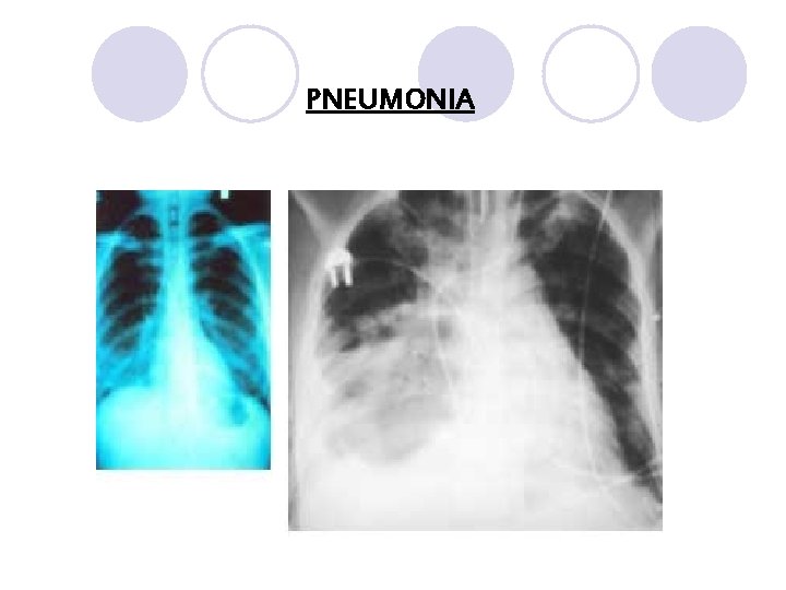 PNEUMONIA 