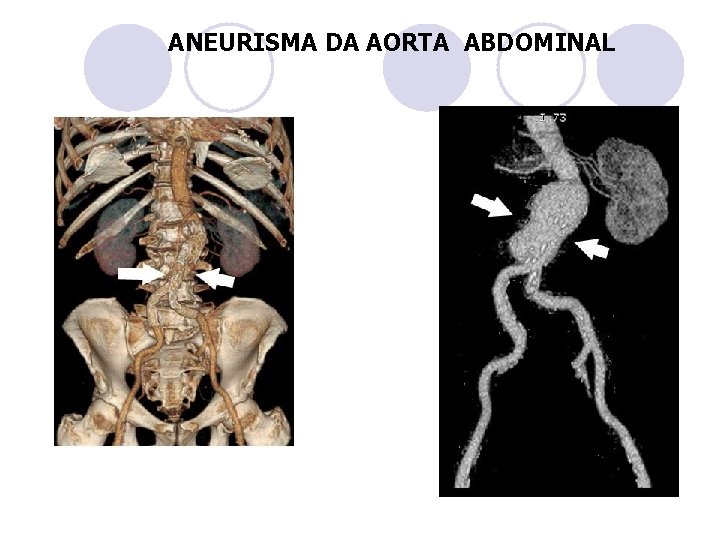  ANEURISMA DA AORTA ABDOMINAL 