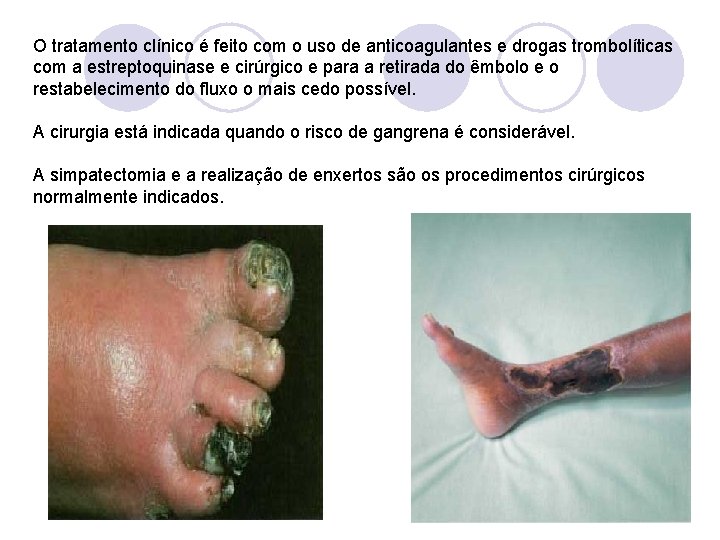 O tratamento clínico é feito com o uso de anticoagulantes e drogas trombolíticas com