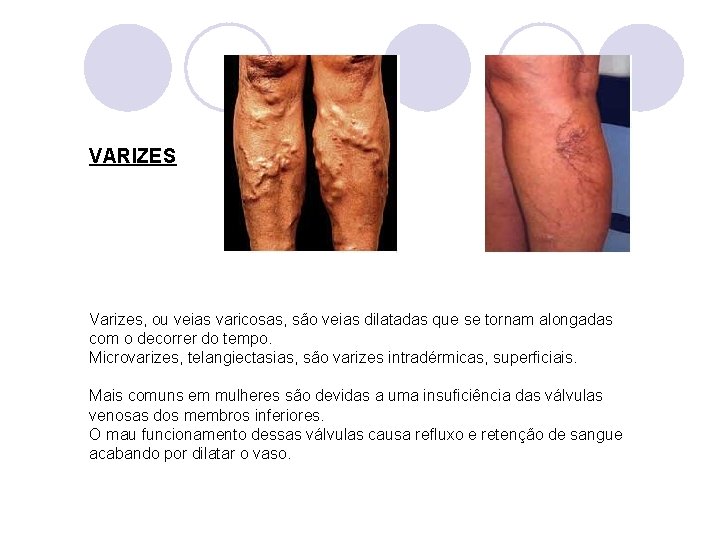 VARIZES Varizes, ou veias varicosas, são veias dilatadas que se tornam alongadas com o