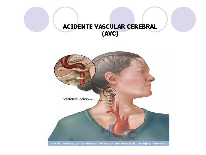 ACIDENTE VASCULAR CEREBRAL (AVC) 