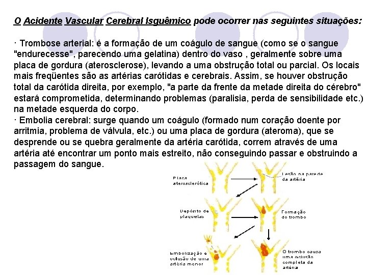 O Acidente Vascular Cerebral lsguêmico pode ocorrer nas seguintes situações: · Trombose arterial: é