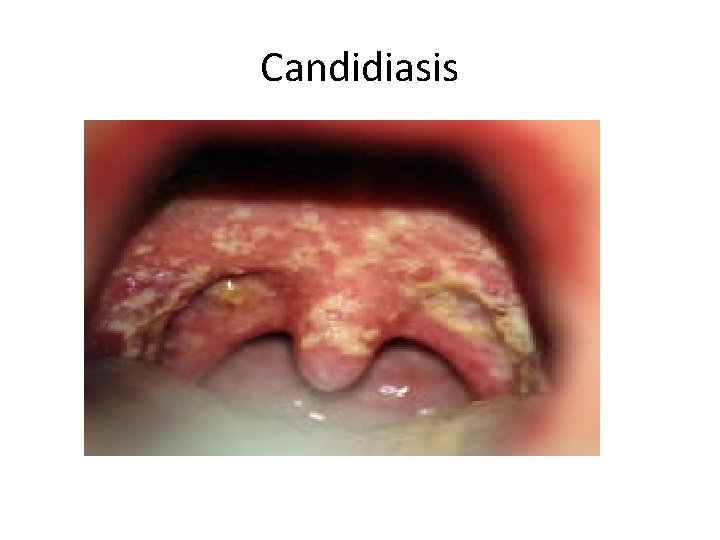 Candidiasis 
