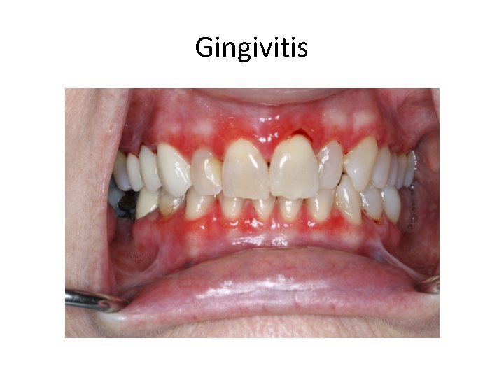 Gingivitis 