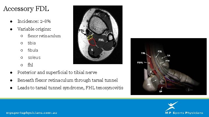 Accessory FDL ● Incidence: 2 -8% ● Variable origins: ○ flexor retinaculum ○ tibia