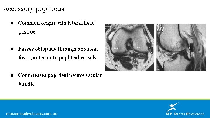 Accessory popliteus ● Common origin with lateral head gastroc ● Passes obliquely through popliteal