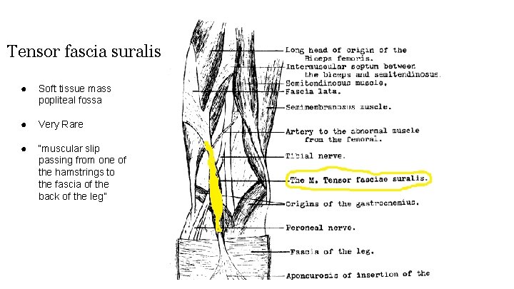 Tensor fascia suralis ● Soft tissue mass popliteal fossa ● Very Rare ● “muscular