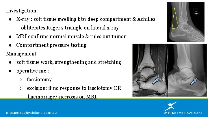 Investigation ● X-ray : soft tissue swelling btw deep compartment & Achilles – obliterates