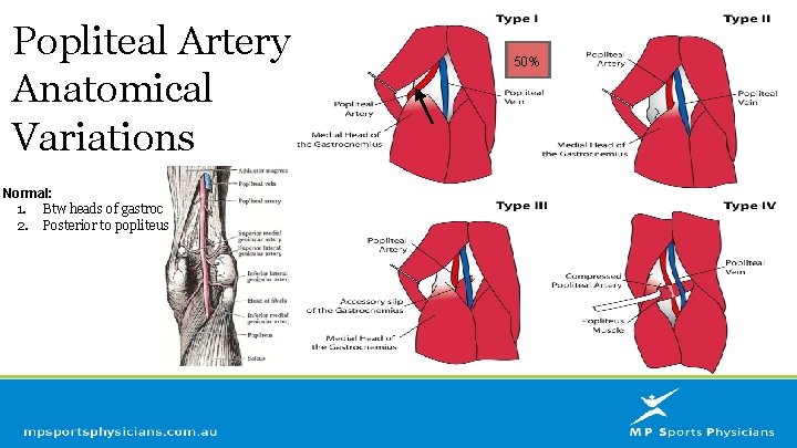 Popliteal Artery Anatomical Variations Normal: 1. Btw heads of gastroc 2. Posterior to popliteus