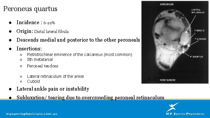 Peroneus quartus ● Incidence : 6 -22% ● Origin: Distal lateral fibula ● Descends