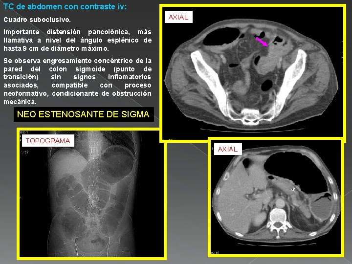 TC de abdomen contraste iv: Cuadro suboclusivo. AXIAL Importante distensión pancolónica, más llamativa a