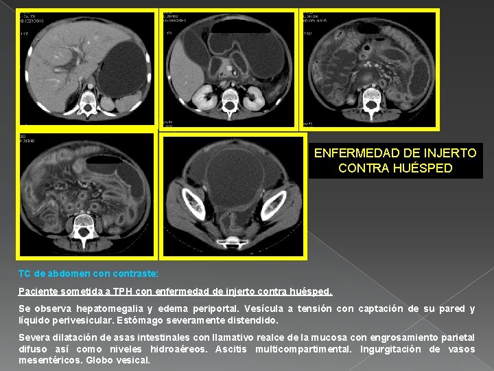 ENFERMEDAD DE INJERTO CONTRA HUÉSPED TC de abdomen contraste: Paciente sometida a TPH con