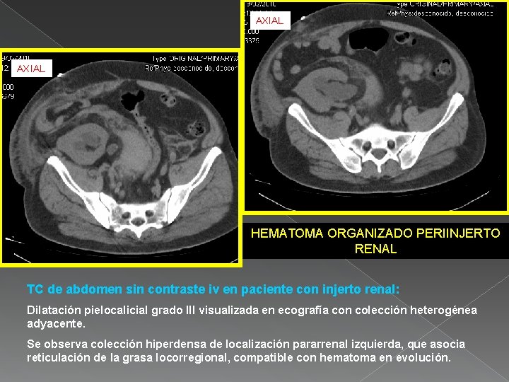 AXIAL HEMATOMA ORGANIZADO PERIINJERTO RENAL TC de abdomen sin contraste iv en paciente con