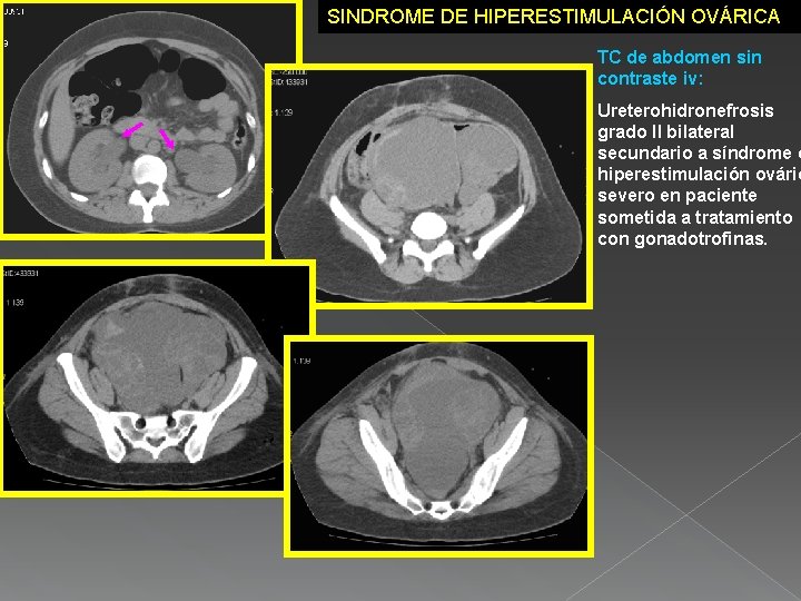 SINDROME DE HIPERESTIMULACIÓN OVÁRICA TC de abdomen sin contraste iv: Ureterohidronefrosis grado II bilateral