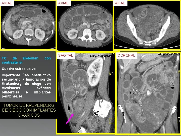 AXIAL TC de abdomen contraste iv: AXIAL con Cuadro suboclusivo. Importante íleo obstructivo secundario